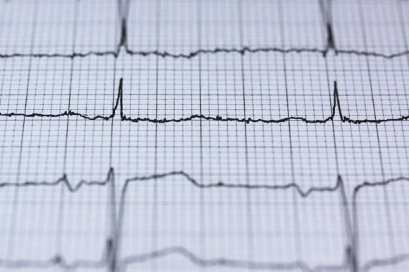 [Enlace] Un algoritmo consigue detectar arritmias con más precisión que los cardiólogos
